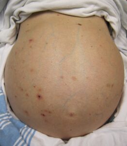 Why Is My Stomach Swollen?